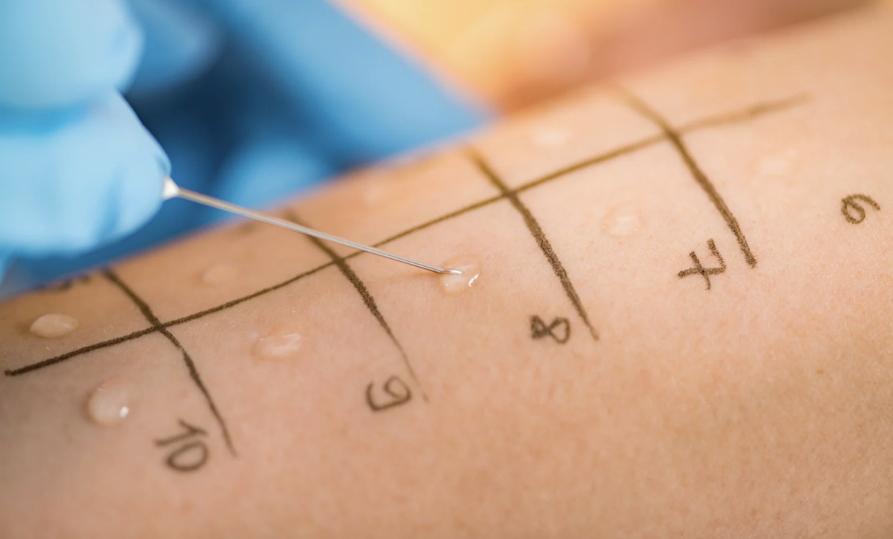 Skin prick allergy test being administered to identify immediate allergic reactions.