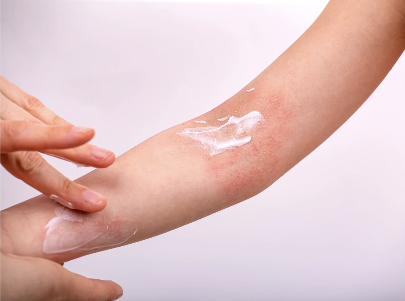 Hand applying soothing cream to a red, irritated patch of skin on the forearm, representing eczema or skin inflammation treatment.