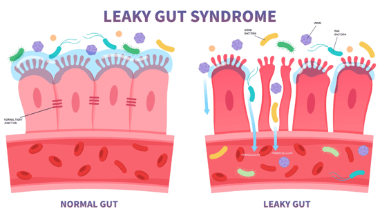 leaky gut resized