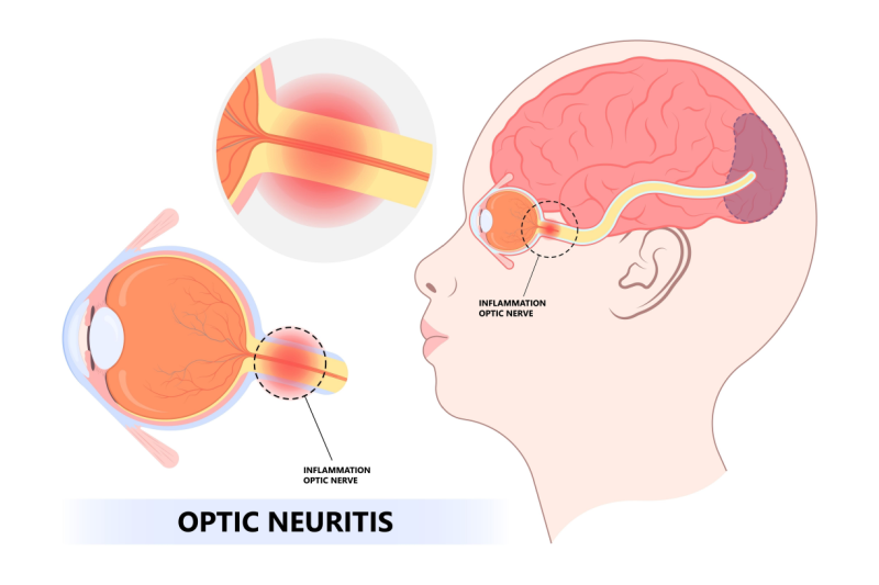optic neuritis