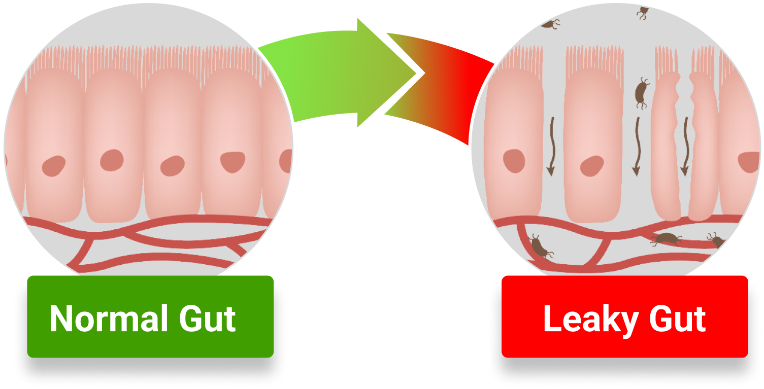 Normal-vs-Leaky-Gut